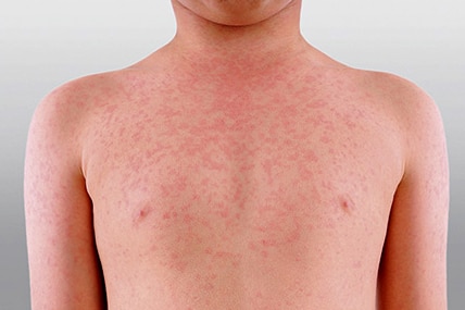 Measles outbreaks in South-East Asia bringing cases to Australia