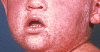 Measles outbreaks in South-East Asia bringing cases to Australia